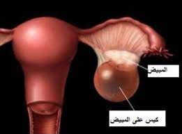 تكيسات المبيض : الأعراض والأسباب والعلاج