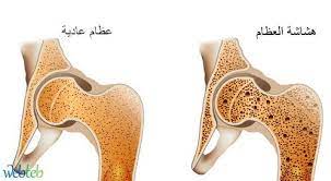 الصدفية والاكتئاب والسكري وهشاشة العظام