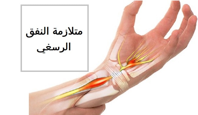 النفق الرسغي