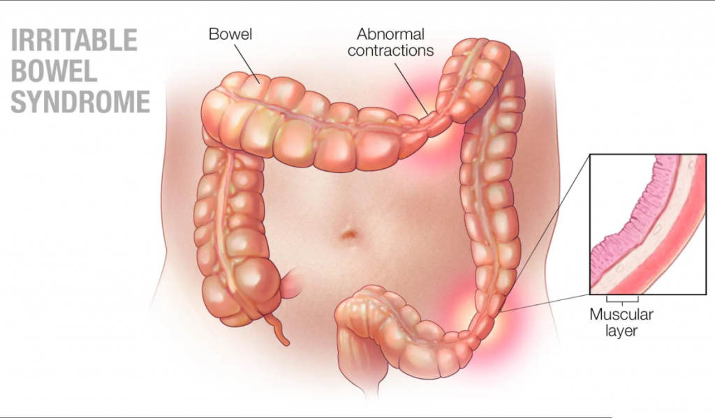 متلازمة القولون العصبي