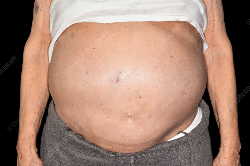 تضخّم الكبد