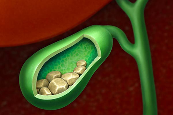 حصى المرارة