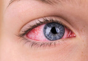 رفّة العين اليسرى