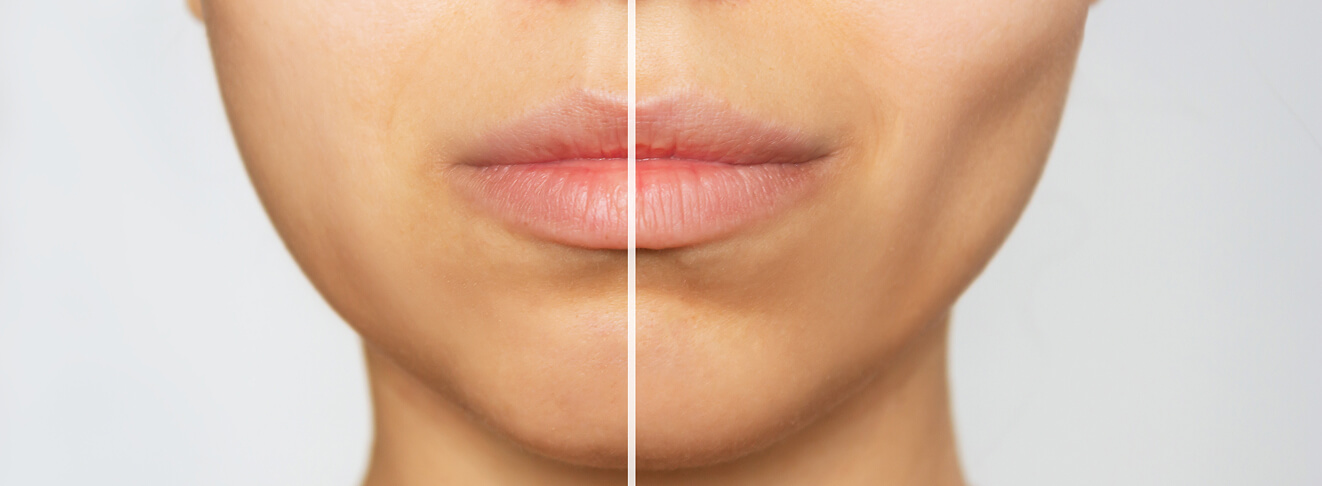 كيف أسمّن وجهي