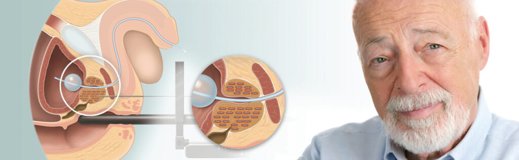 أسباب الإصابة بالبروستات