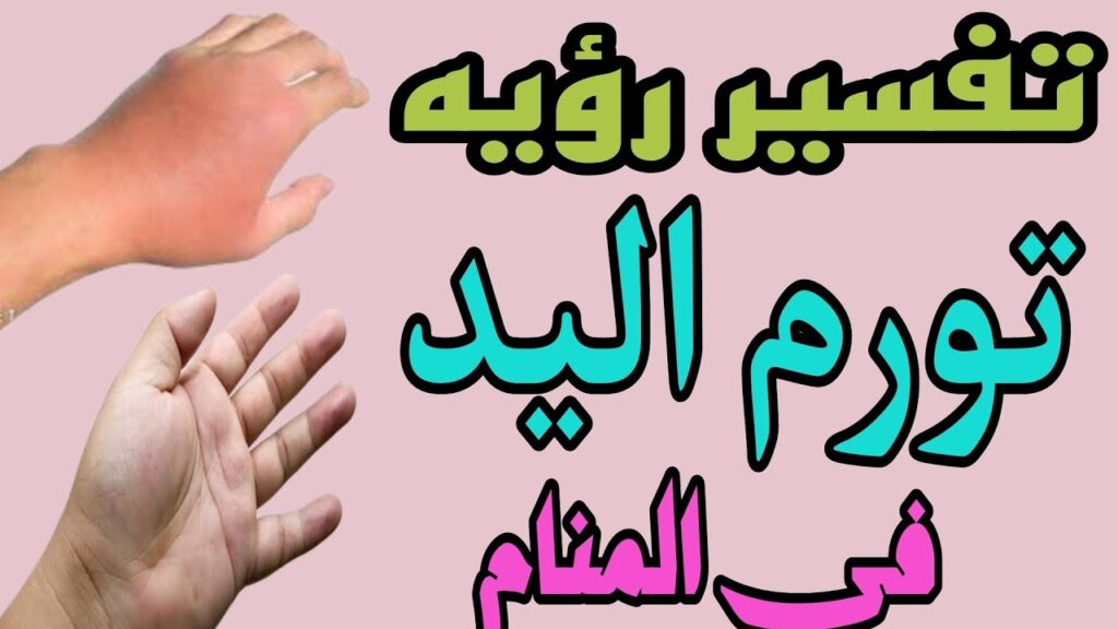 متورمة